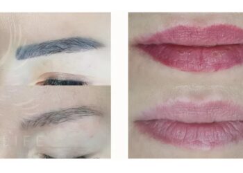 Видалення татуажу — сучасні методи, безпечні технології та відновлення природності